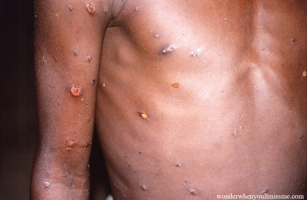 As monkeypox ขณะที่กรณีโรคฝีฝีฝีดาษเพิ่มขึ้นทั่วโลก องค์การอนามัยโลกได้เรียกร้องให้กลุ่มที่ได้รับผลกระทบจากไวรัสมากที่สุดในปัจจุบัน 